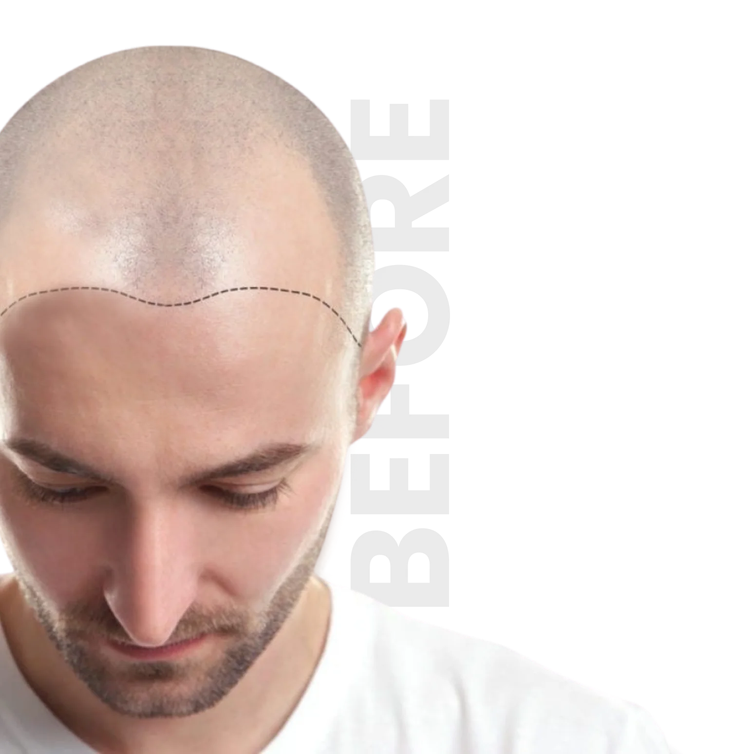 before hair transformation - Dallas Restoration Clinic