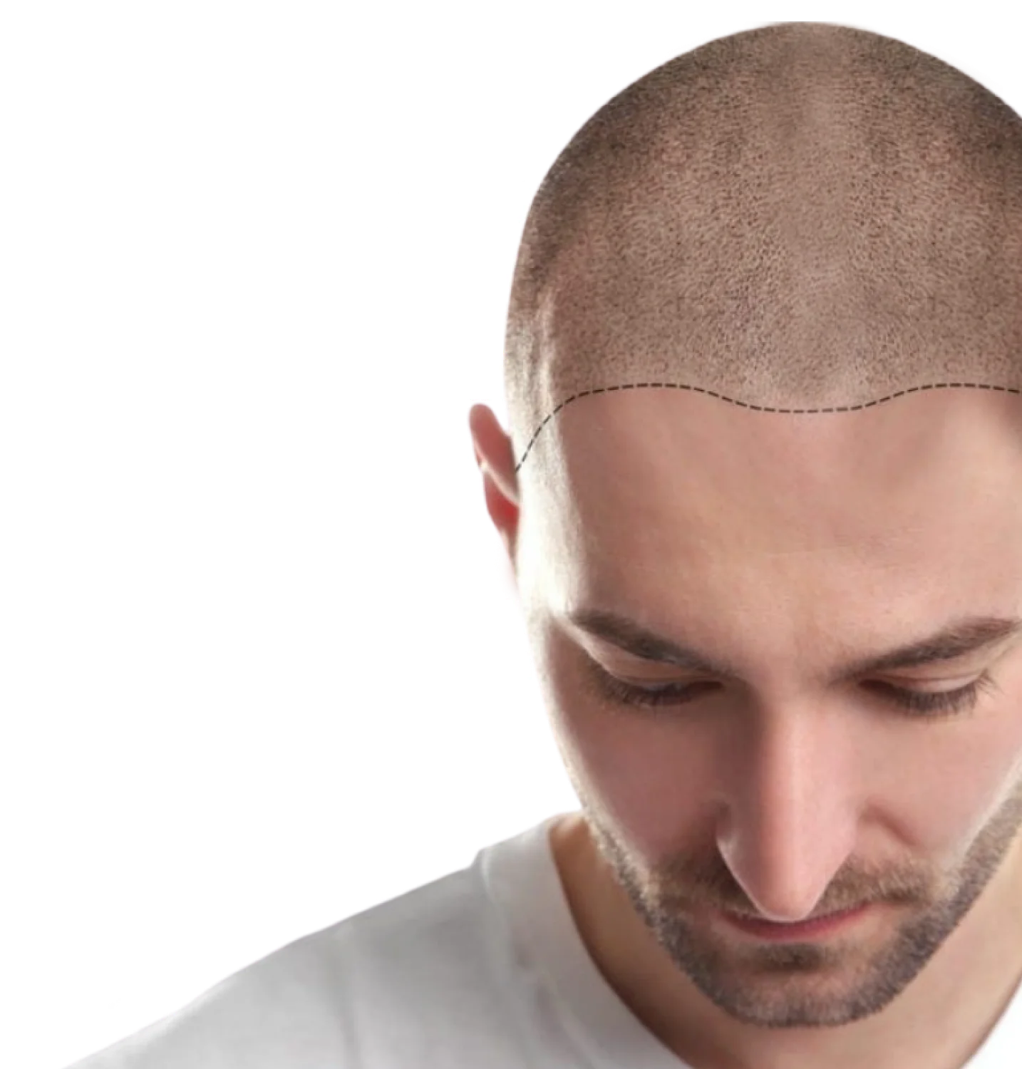 after hair transformation - Dallas Restoration Clinic