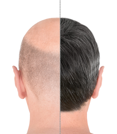 Hair Transplant Virtual Consults