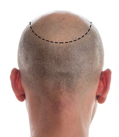 FUT Hair Transplant – Follicular Unit Transplantation