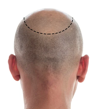 FUT Hair Transplant