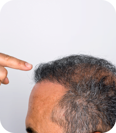 FUE Hair Transplant Dallas Follicular Unit Extraction