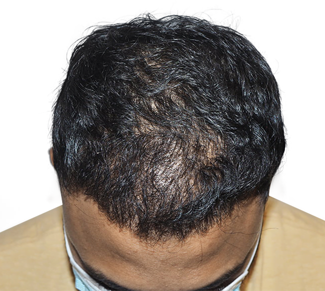Hair Transplant Dallas StateoftheArt Hair Restoration Procedures