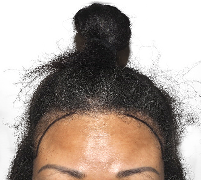 Hair Transplant Dallas StateoftheArt Hair Restoration Procedures