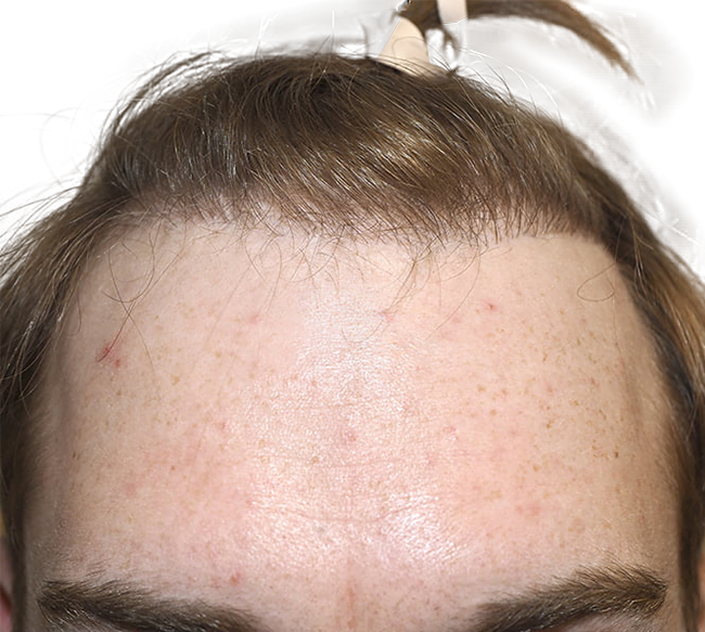 Hair Transplant Dallas StateoftheArt Hair Restoration Procedures