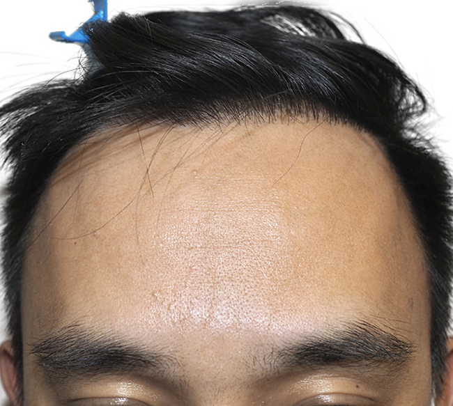Hair Transplant Dallas StateoftheArt Hair Restoration Procedures