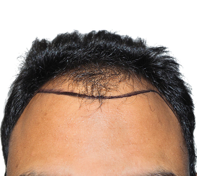 Hair Transplant Dallas StateoftheArt Hair Restoration Procedures