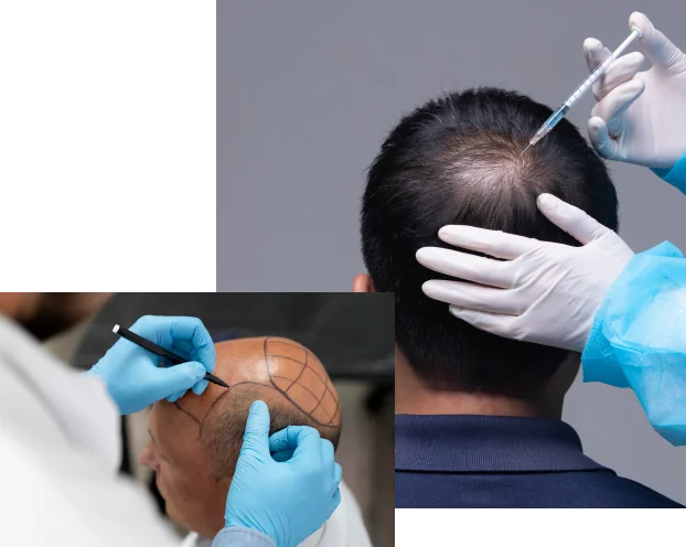 Hair transplant procedure: scalp markings and injection. Hair Transplant Center Dallas TX
