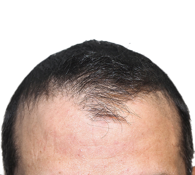 Hair Transplant Dallas StateoftheArt Hair Restoration Procedures