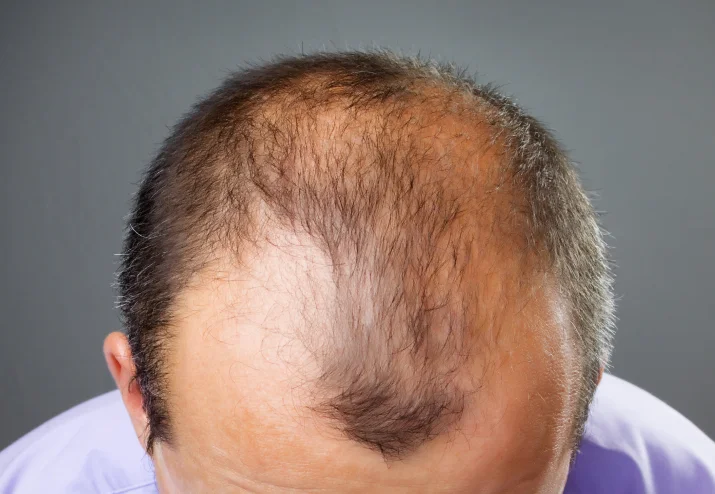 Mans head with thinning hair on top. Hair Transplant Center Dallas TX