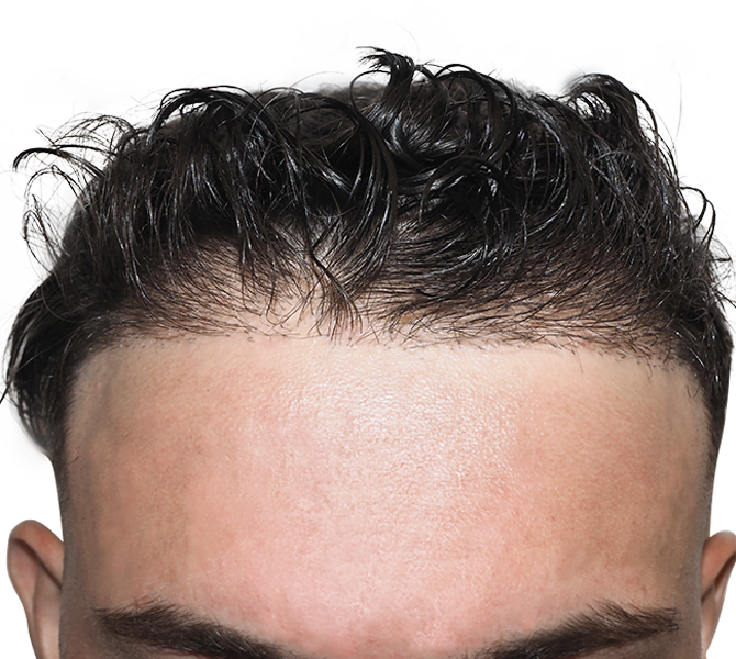 Hair Transplant Dallas StateoftheArt Hair Restoration Procedures