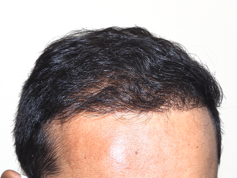 Cost Of Hair Transplant In Dallas Dallas Hair Transplant Center - Dr. Stefan Thiele