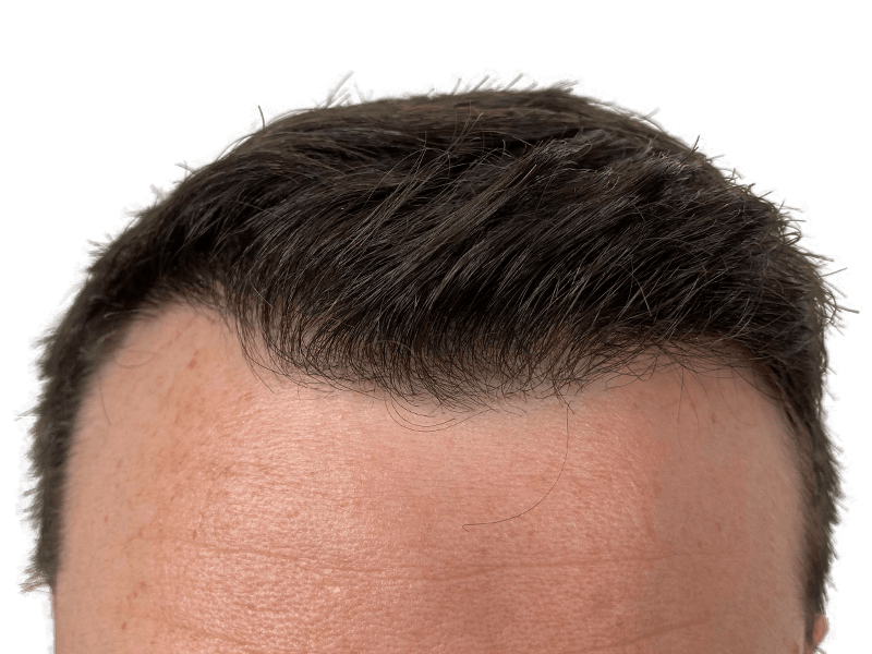 Cost Of Hair Transplant In Dallas Dallas Hair Transplant Center - Dr. Stefan Thiele
