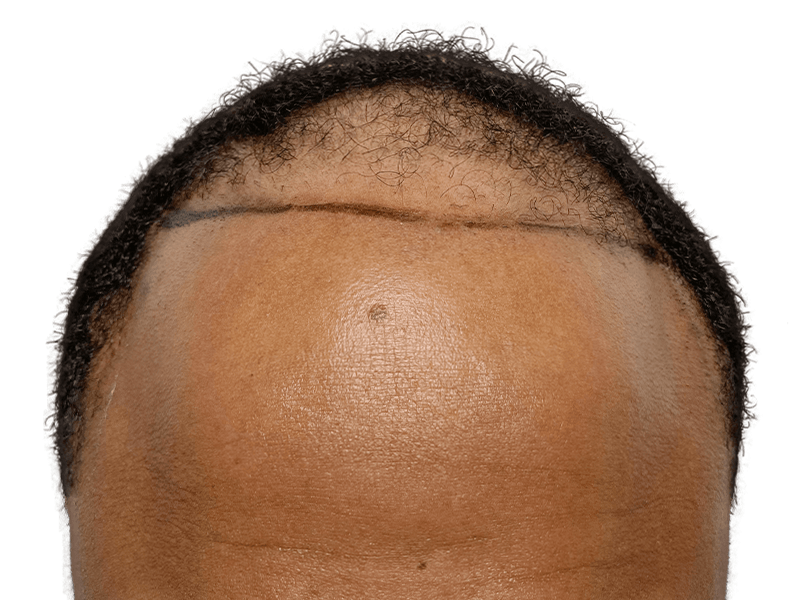 Cost Of Hair Transplant In Dallas Dallas Hair Transplant Center - Dr. Stefan Thiele