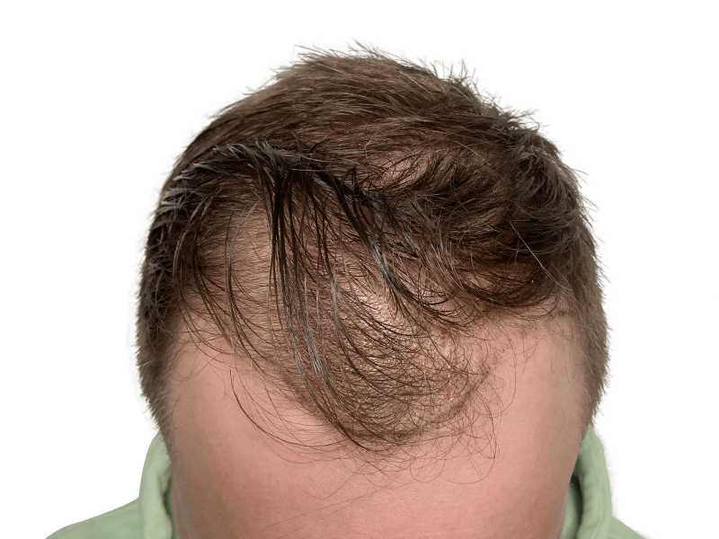 Cost Of Hair Transplant In Dallas Dallas Hair Transplant Center - Dr. Stefan Thiele